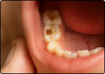 2. Cavities Keep Coming Back 😩